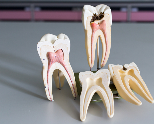 Model of health tooth compared with damaged tooth used to explain pulp therapy