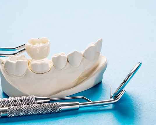 A metal-free dental crown and mouth mold with dental instruments